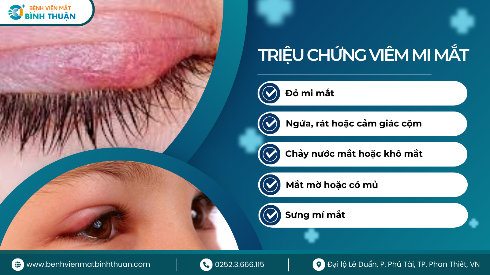Viêm Mi Mắt: Nguyên Nhân, Triệu Chứng và Phương Pháp Điều Trị Hiệu Quả