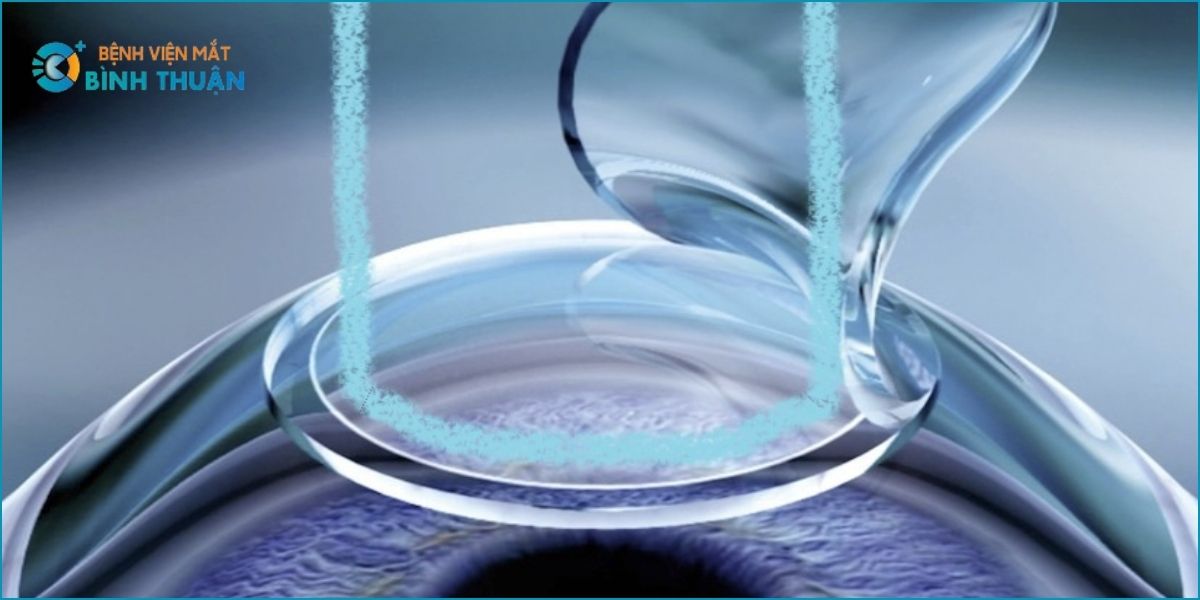 PHẪU THUẬT FEMTO - LASIK FEMTO 
